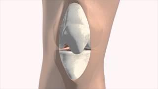 Total Knee Replacement - Patient Education