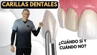 Carillas dentales de porcelana  Indicaciones y contraindicaciones