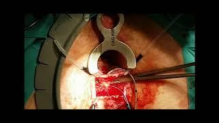 Ligation of Intersphincteric Fistula Tract LIFT procedure for the treatment of fistula-in-ano