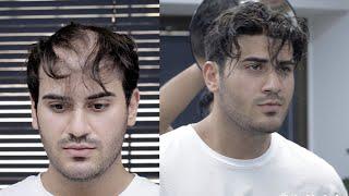 PROTEZ SAÇ UYGULAMASI - Kaliteyi Hisset - Hair Replacement