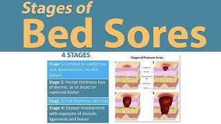 Stages of Bed sores  Pressure Sores