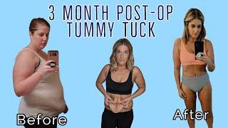 Tummy Tuck 3 Months Post Op Skin Removal After Weight Loss