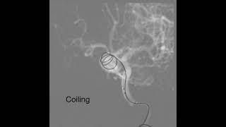 Flow Diverter Assisted Coiling