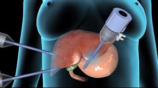 Cholecystectomy  Gallbladder Removal Surgery  Nucleus Health