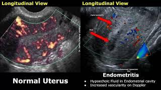 Uterus & Adnexa Ultrasound Normal Vs Pelvic Inflammatory Disease PID Images  Gynecological USG