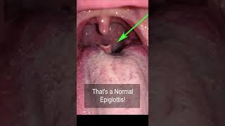 ENT strange factoids. The “It is abnormal” But is actually normal epiglottis #shorts @fauquierent