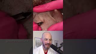 Derm reacts to ingrown hair pimple pop combo #dermreacts #doctorreacts #pimplepop #ingrownhair