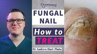 How to TREAT Fungal Nail  Get Rid Of Nail Fungus Anti-Fungal Lacquer & Tablets