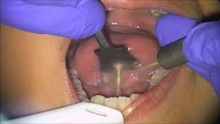 Solea Lingual Frenectomy - Dr. Lawrence Kotlow Narrated