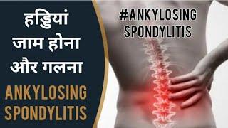 Joint Stiffness Spinal Fusion Inflammation Ankylosing Spondylosis Ayurvedic Cure Nityanandam Shree