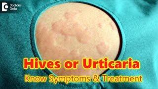 Hives  Urticaria-CausesSymptomsTreatment  Skin Rash  Allergy - Dr.Rasya Dixit  Doctors Circle