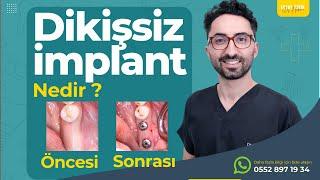 Dikişsiz implant uygulaması nasıl yapılır ? Öncesi Sonrası vaka örneği