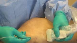 Endovenous Laser Ablation