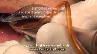 Ameliyatsız Dikişsiz Diş İmplant Kolay Drill Sistemi ile Kolay İmplant  Dt. Bülent Özçağatay