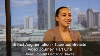 Breast Augmentation for Tuberous Breasts - Video Journey Part One - Dr. S. Larry Schlesinger