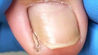 Small sharp corners that remain in the nails of the feet  remove them