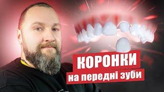  Коронки на передні зуби – які краще поставити?