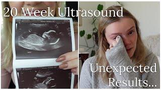 20 Week UltrasoundAnatomy Scan- Seeing Baby & Unexpected Complications 2 Vessel Umbilical Cord
