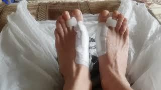 Халюс Вальгус. Hallux valgus. Снятие швов