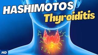 Hashimotos Disease Causes Symptoms and Treatment