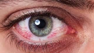 شما و چشمانتان- قرمزی چشم - قسمت 1-دکتر ملیحی -Dr. Malihi