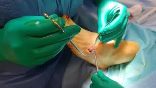 How Does a Ganglionic Cyst Form?