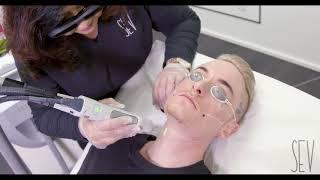 FACE HAIR REMOVAL FOR MEN  SEV LASER