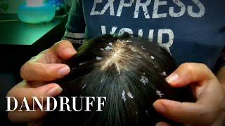  ASMR  DANDRUFF REMOVAL  NO TALKING 