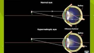 Hypermetropia or Hyperopia