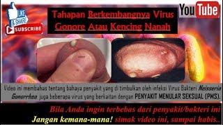 Tahapan Berkembangnya Virus Gonore Atau Kencing Nanah