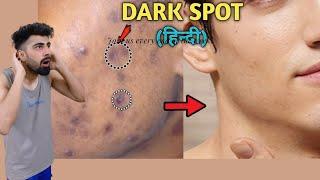 How To Remove DARK SPOTS From Face Naturally  Mridul Madhok