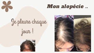 Mon désespoir. ALOPECIE ANDROGENETIQUE ⭐