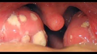 tonsil stones removal throat how remove tonsil stonestonsil