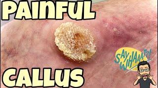 SATISFYING CALLUS REMOVAL FROM FEET