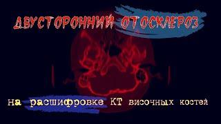 Признаки ОТОСКЛЕРОЗА на КТ и СКЛЕРОТИЧЕСКИХ ИЗМЕНЕНИЙ сосцевидного отростка на расшифровке КТ