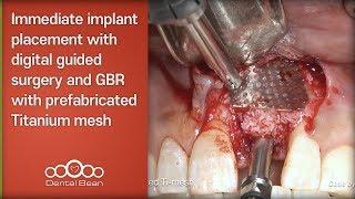 Immediate implant placement with digital guided surgery and GBR with prefabricated Titanium