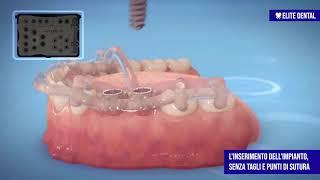 Chirurgia Guidata in Implantologia - Elite Dental e Aratravel