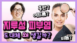 지긋지긋한 지루성 피부염의 발생 원인은 바로 이것 - 박치영의 피부 톡톡 #02