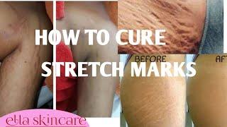 HOW TO CURE STRETCH MARKS  HOW TO PROMIX STRETCH MARKS LOTION