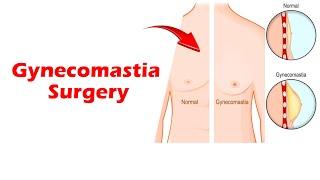 Gynecomastia Surgery  Gland removal