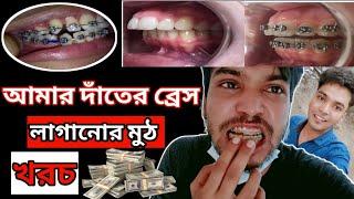 দাঁতে Braces লাগানোর খরচ কত  ফাঁকা দাঁতের চিকৎসা  দাঁত সোজা করতে কত টাকা লাগে  Braces Off