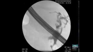 Gall Bladder Carcinoma with Invasion of the Common Bile Duct