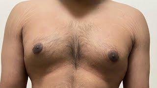 Guy from Mumbai for gynecomastia treatment