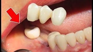 Làm cầu răng sứ cho trường hợp mất răng hàm bridge crown