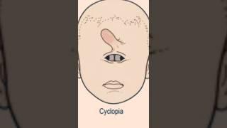 Cyclopia The Terrifying Truth About One-Eyed Newborns #shorts