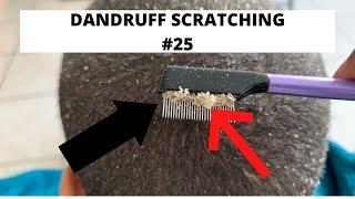 Dandruff scratching #25