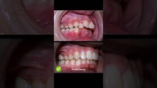 Braces overbite treatment #braces #orthodontist #dentist #dental