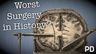 The Dark side of Science The Lobotomy the worst surgery in history? Documentary