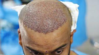Hair Transplant Live Surgery  Hair Transplant FUE Technique Best Hair Transplant results