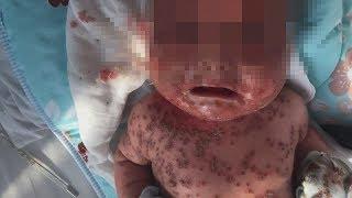 Mom Infects Her Baby with Herpes?